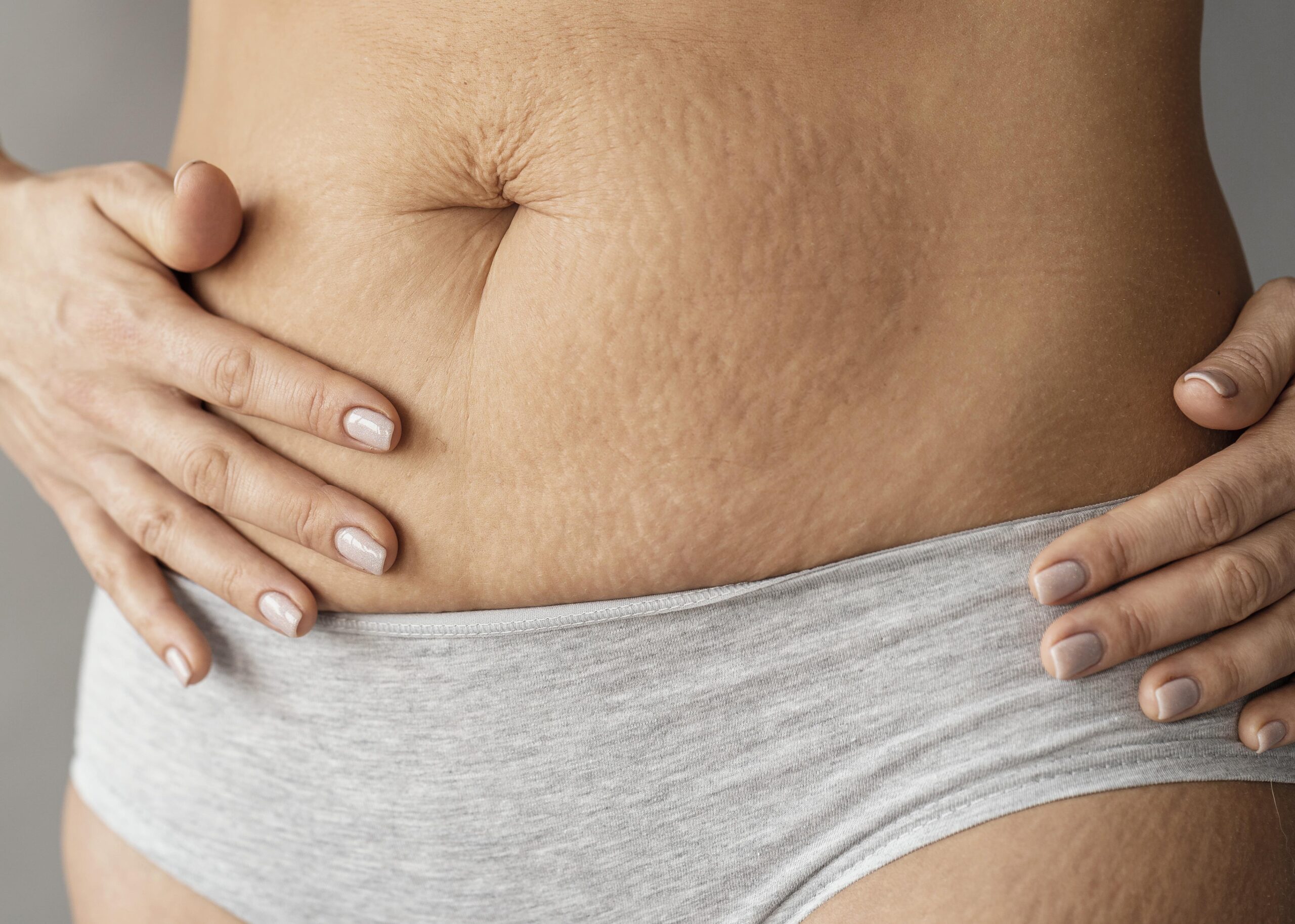 close up woman with stretch marks scaled